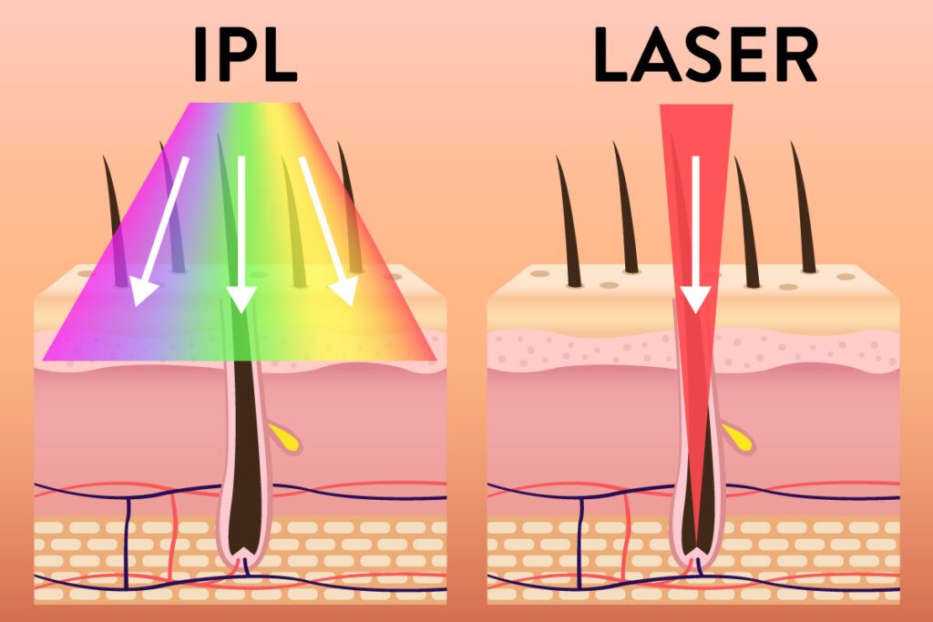 graphic_difference_between_ipl_and_laser_hair_removal